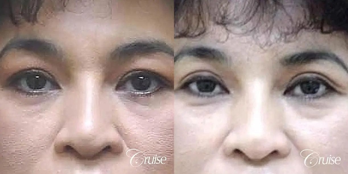 Blepharoplasty Before & After