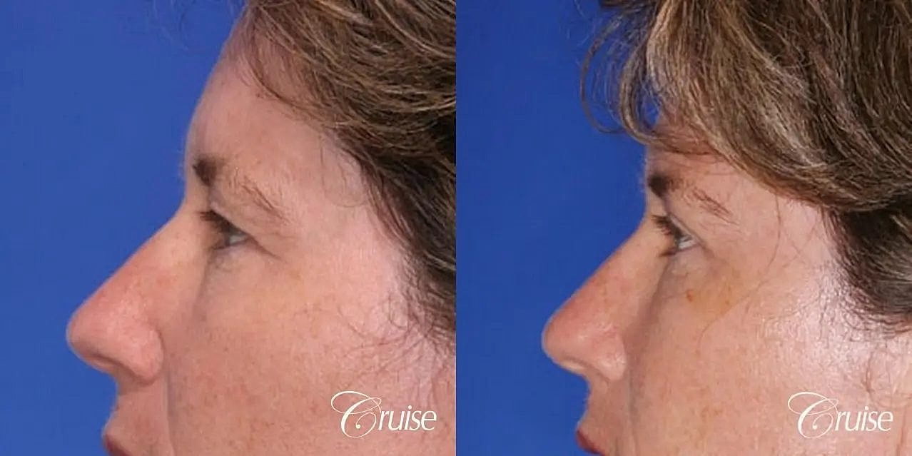 Blepharoplasty Before & After