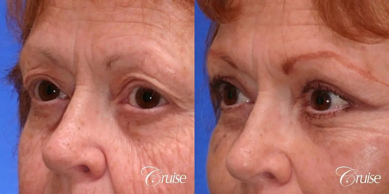Blepharoplasty Before & After