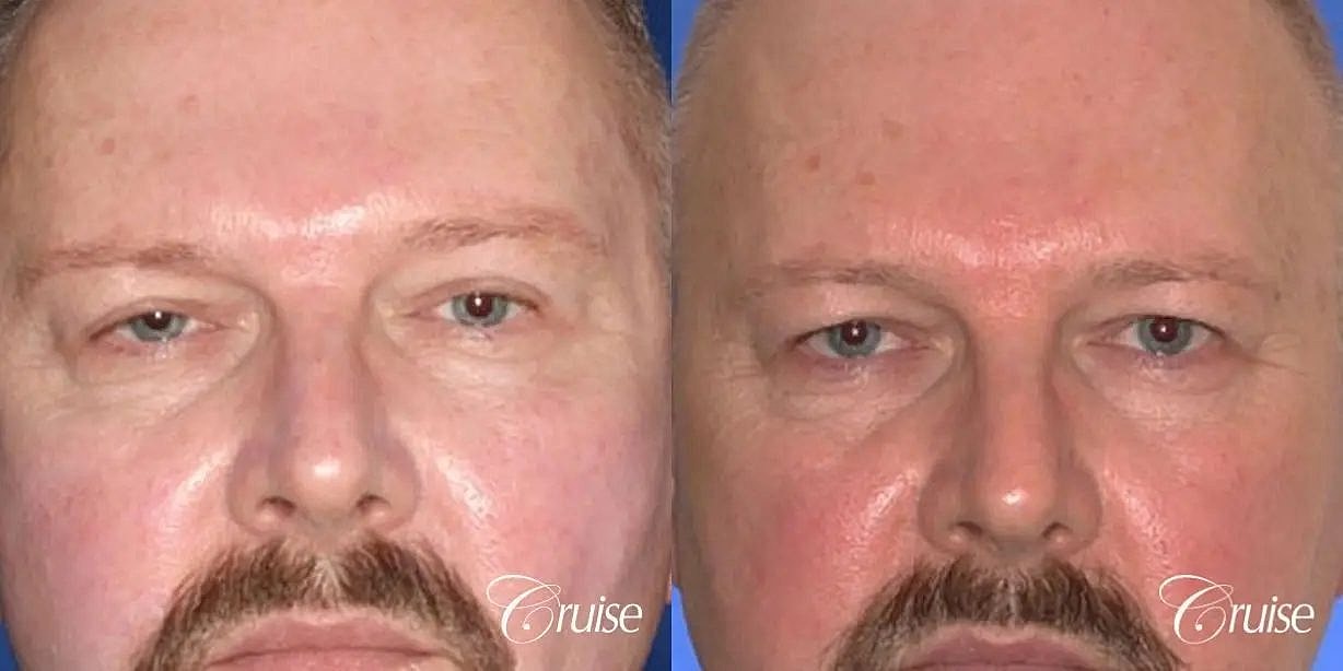 Blepharoplasty Before & After