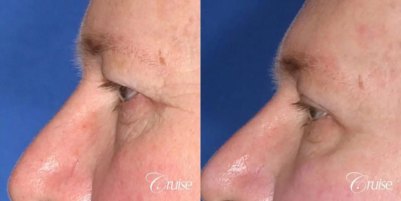 Blepharoplasty Before & After