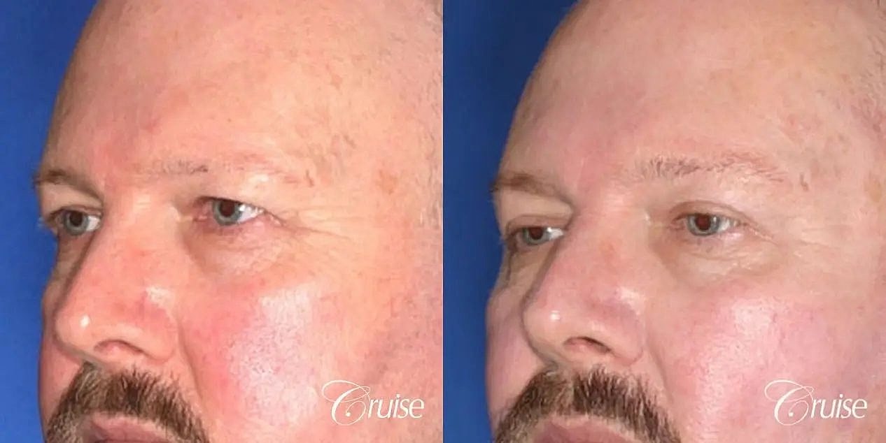 Blepharoplasty Before & After
