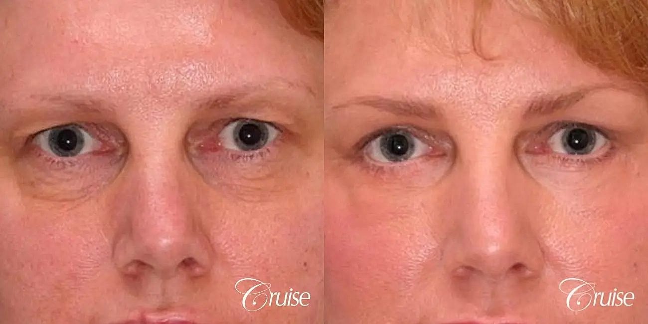 Blepharoplasty Before & After