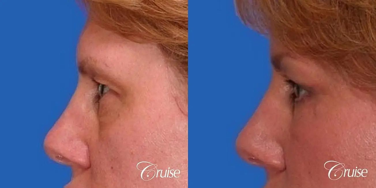 Blepharoplasty Before & After