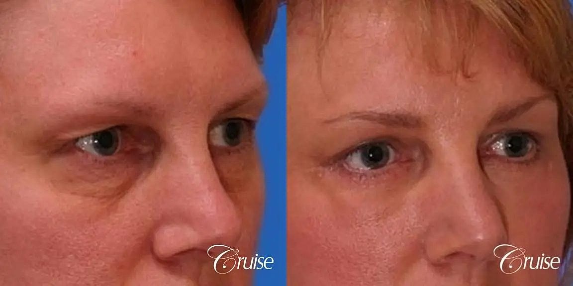 Blepharoplasty Before & After