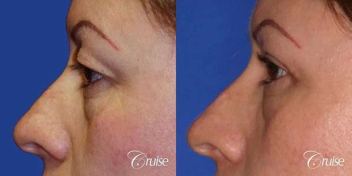 Blepharoplasty Before & After