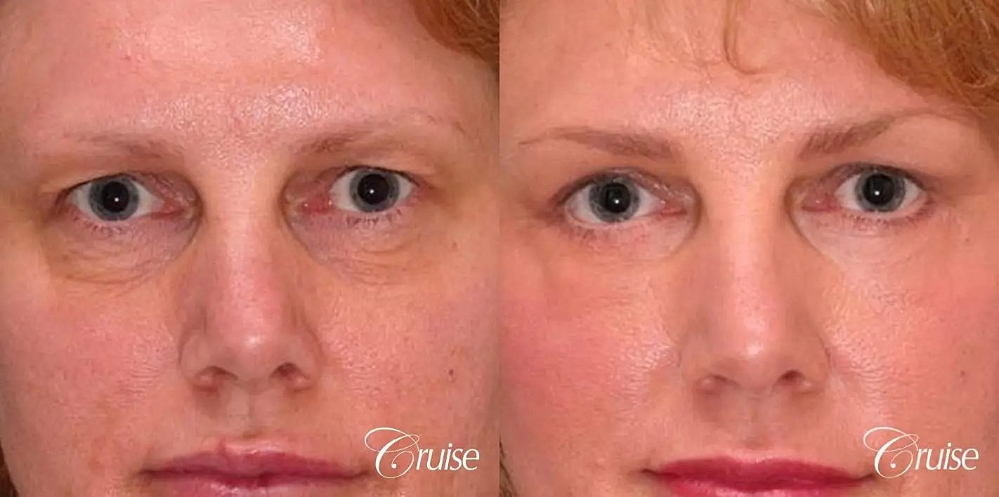 Blepharoplasty Before & After