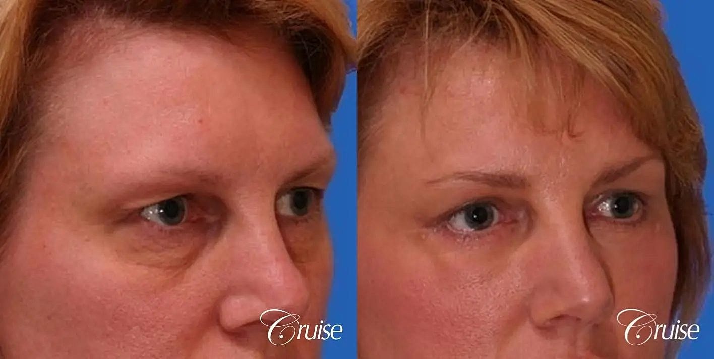 Blepharoplasty Before & After