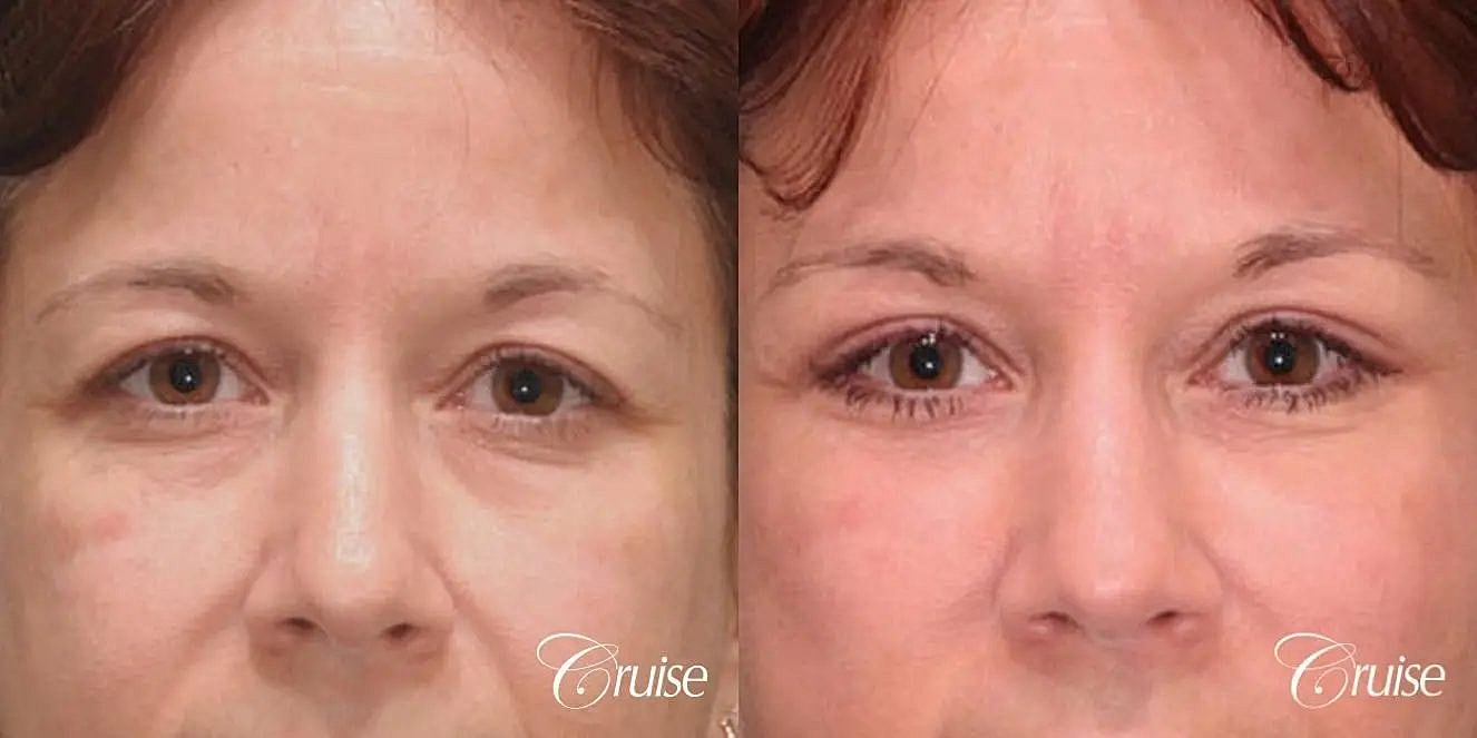 Blepharoplasty Before & After