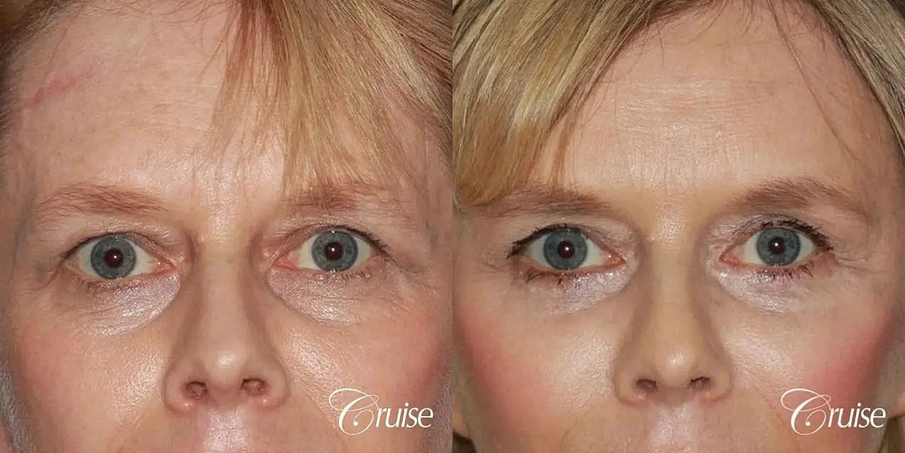 Blepharoplasty Before & After