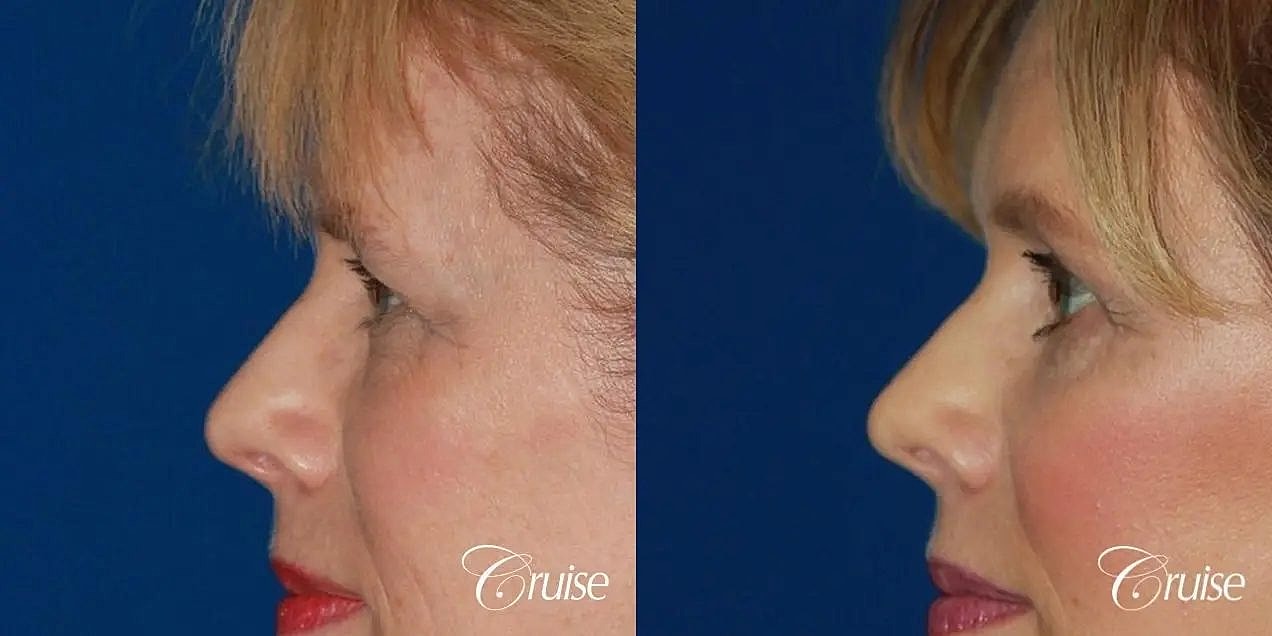 Blepharoplasty Before & After
