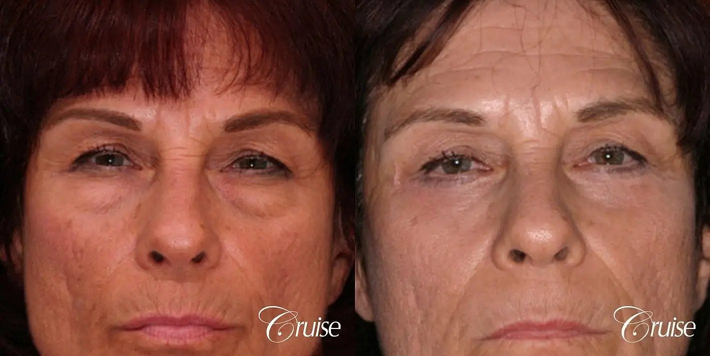 Blepharoplasty Before & After