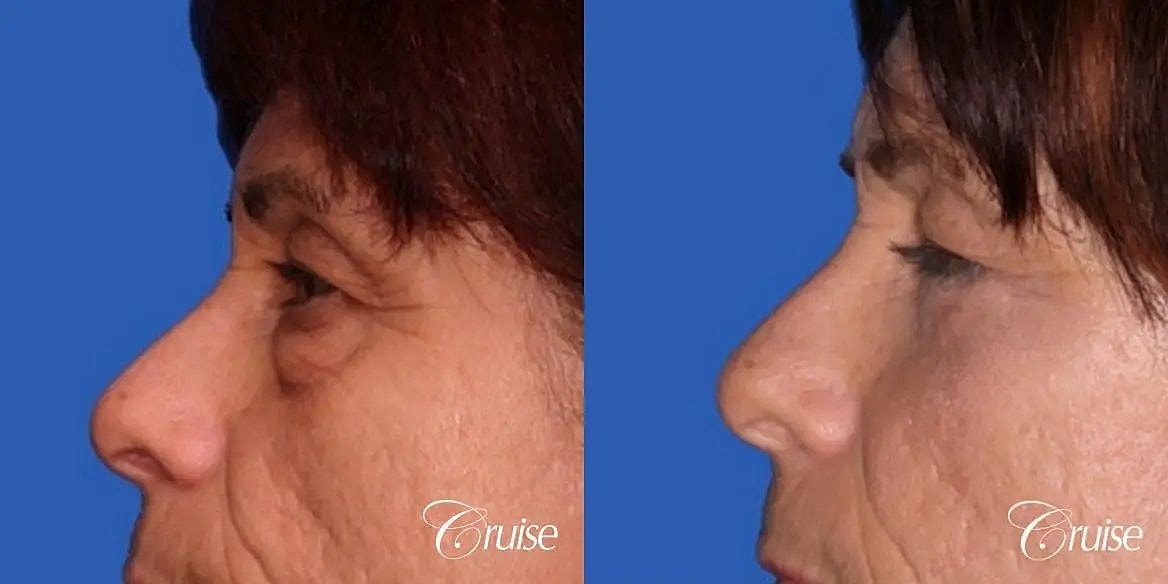 Blepharoplasty Before & After