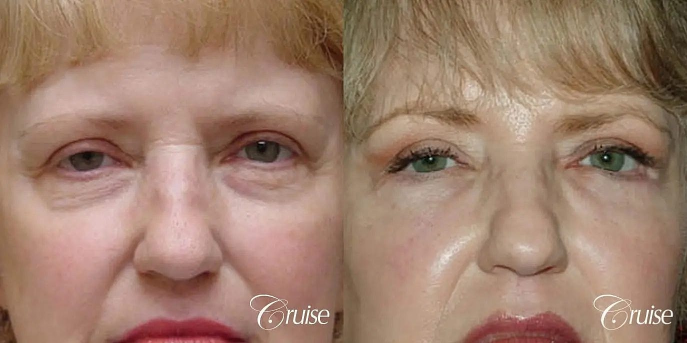 Blepharoplasty Before & After