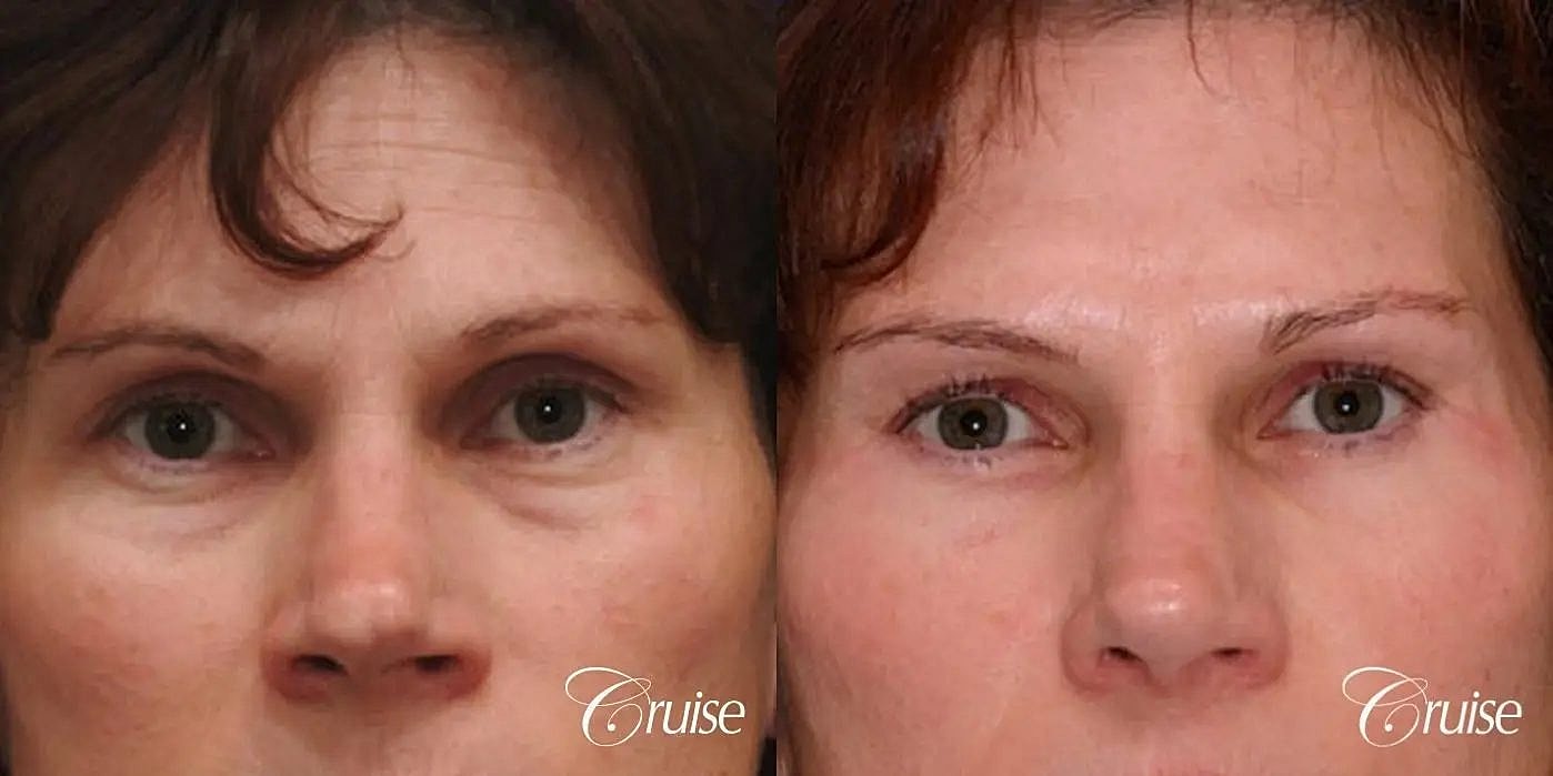 Blepharoplasty Before & After
