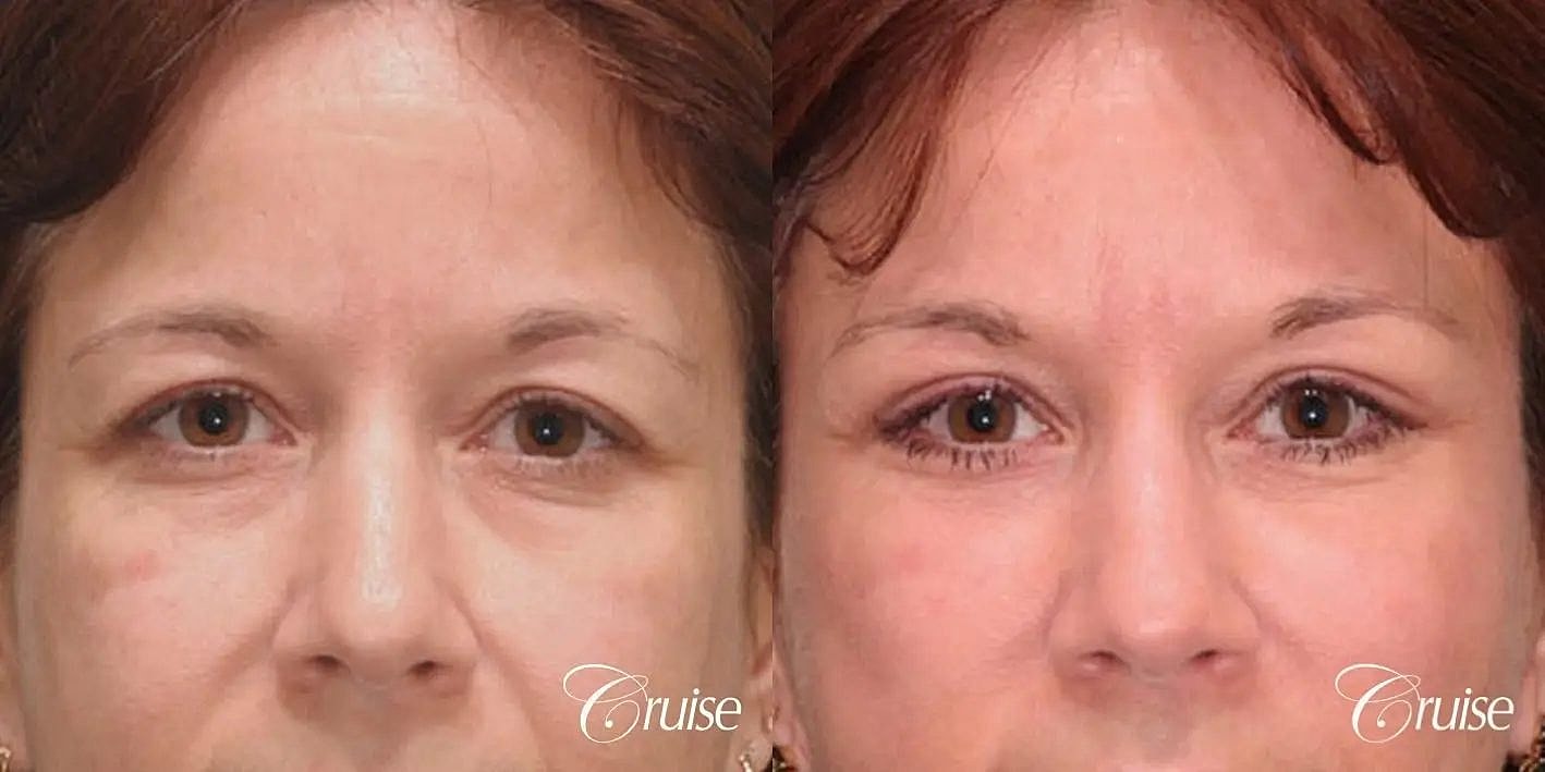 Blepharoplasty Before & After