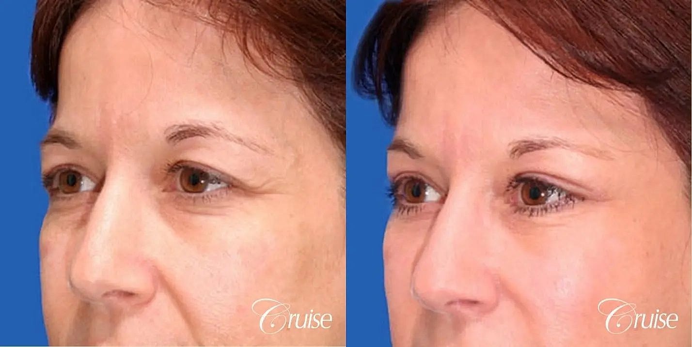 Blepharoplasty Before & After