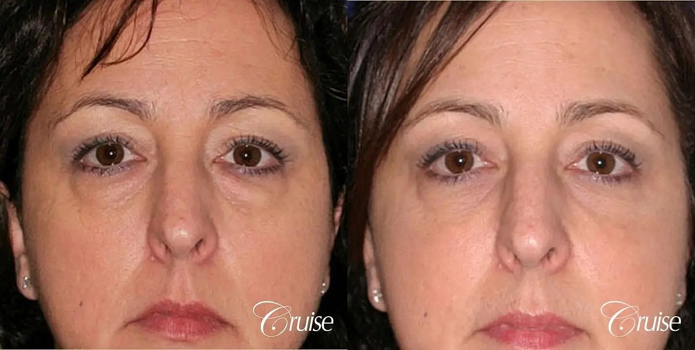 Blepharoplasty Before & After