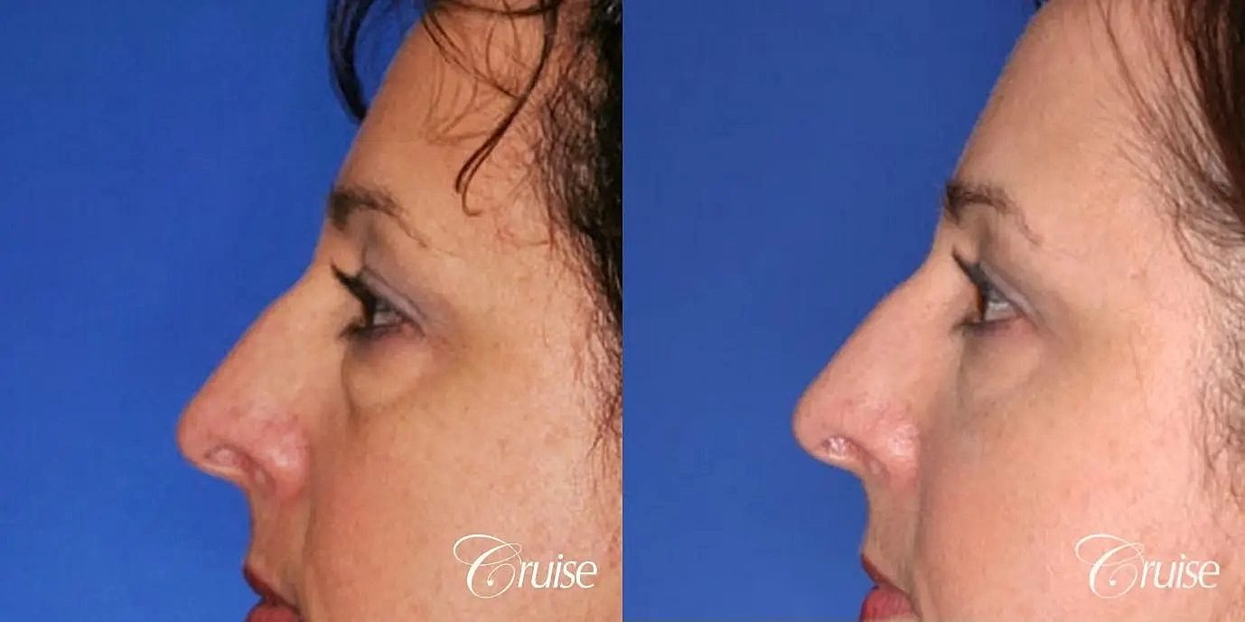 Blepharoplasty Before & After