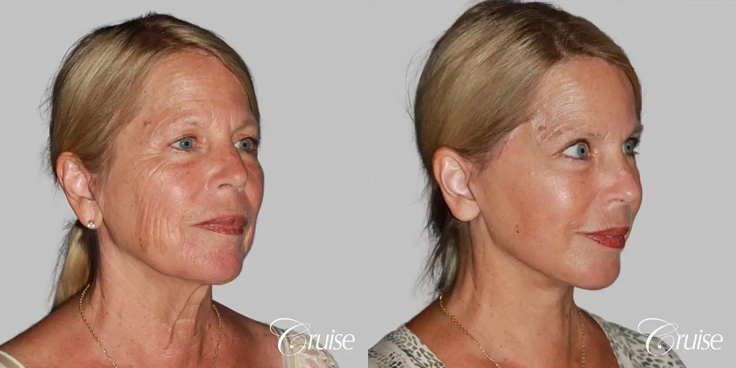 Face Lift Before & After