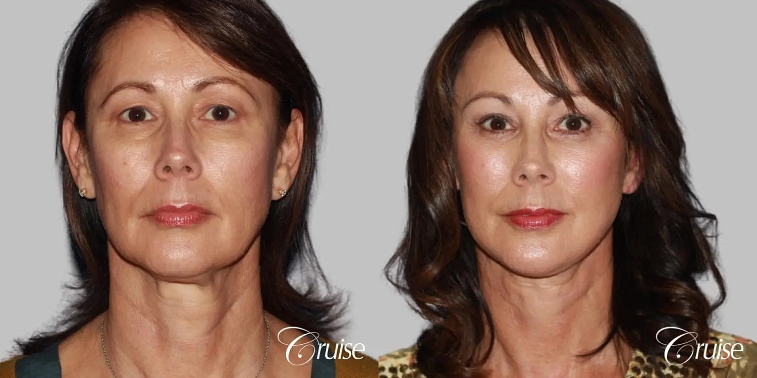 Face Lift Before & After