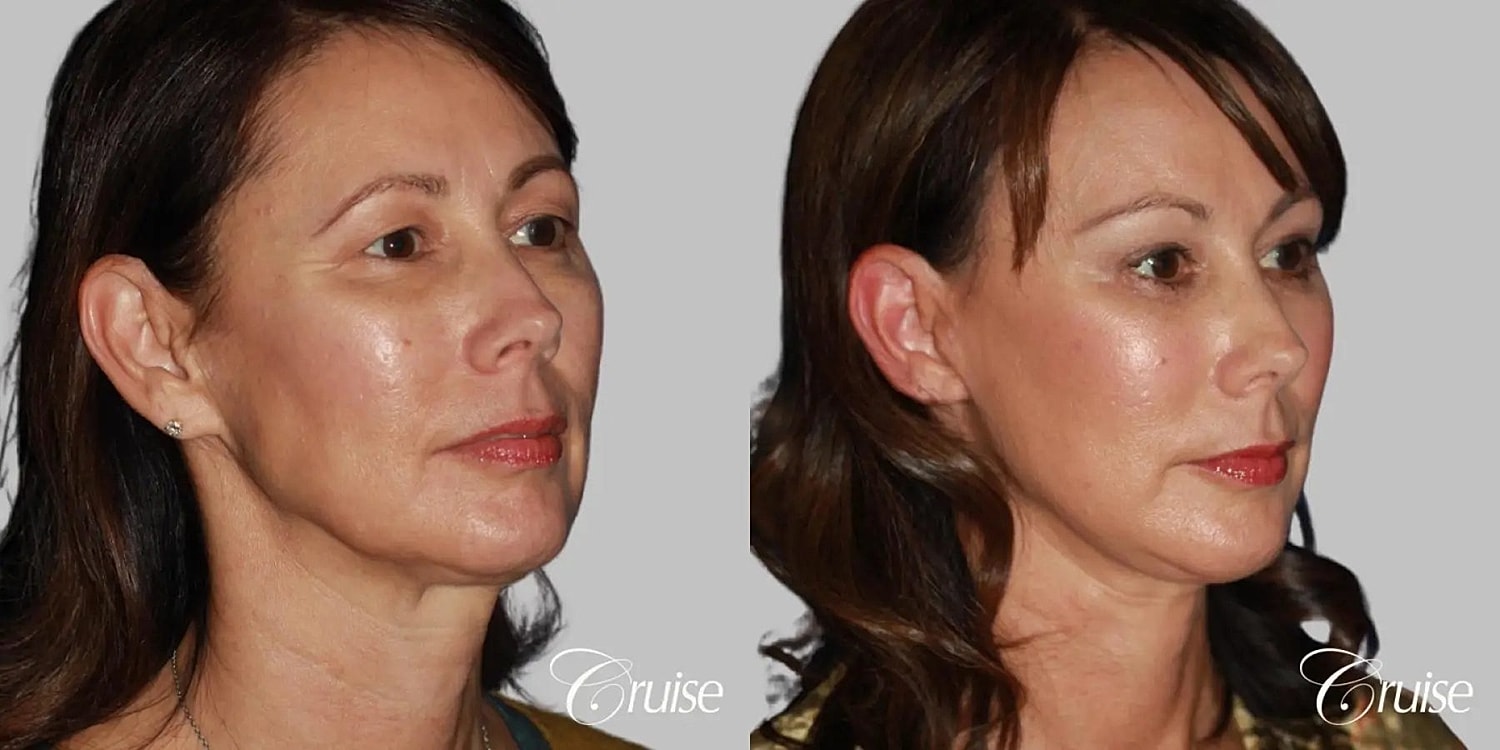 Face Lift Before & After