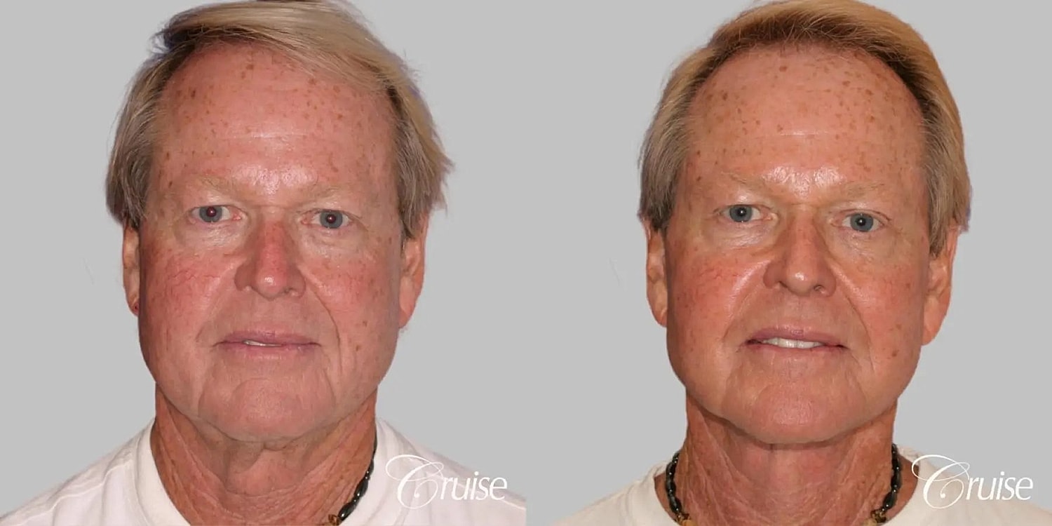 Face Lift Before & After