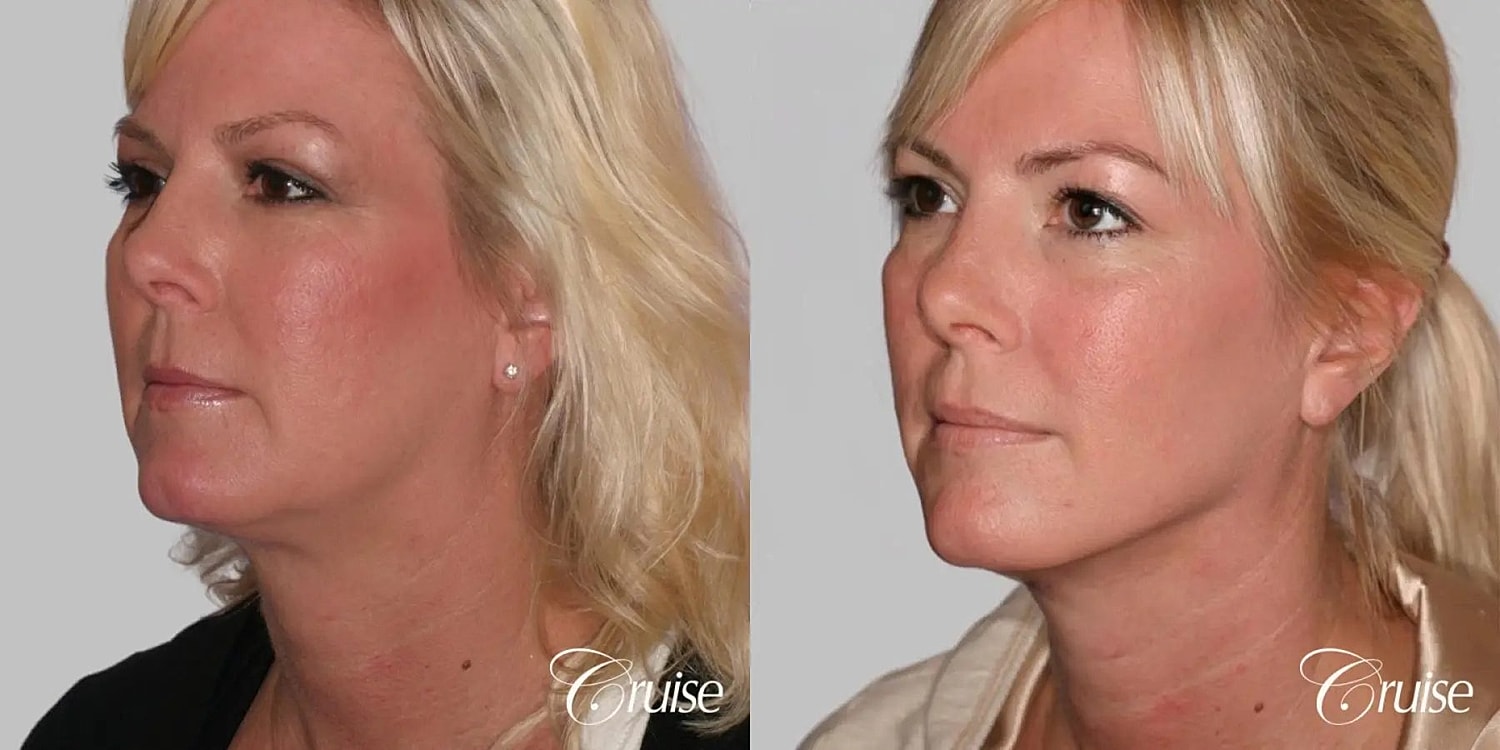 Face Lift Before & After