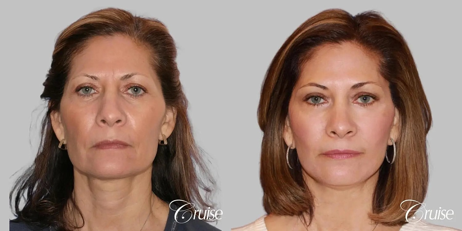 Face Lift Before & After