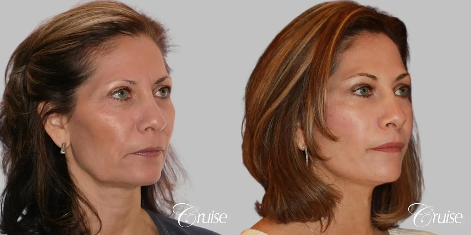 Face Lift Before & After