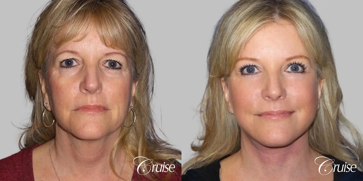 Face Lift Before & After