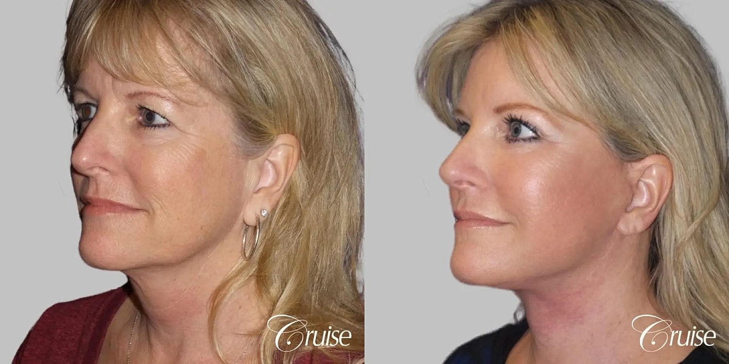 Face Lift Before & After