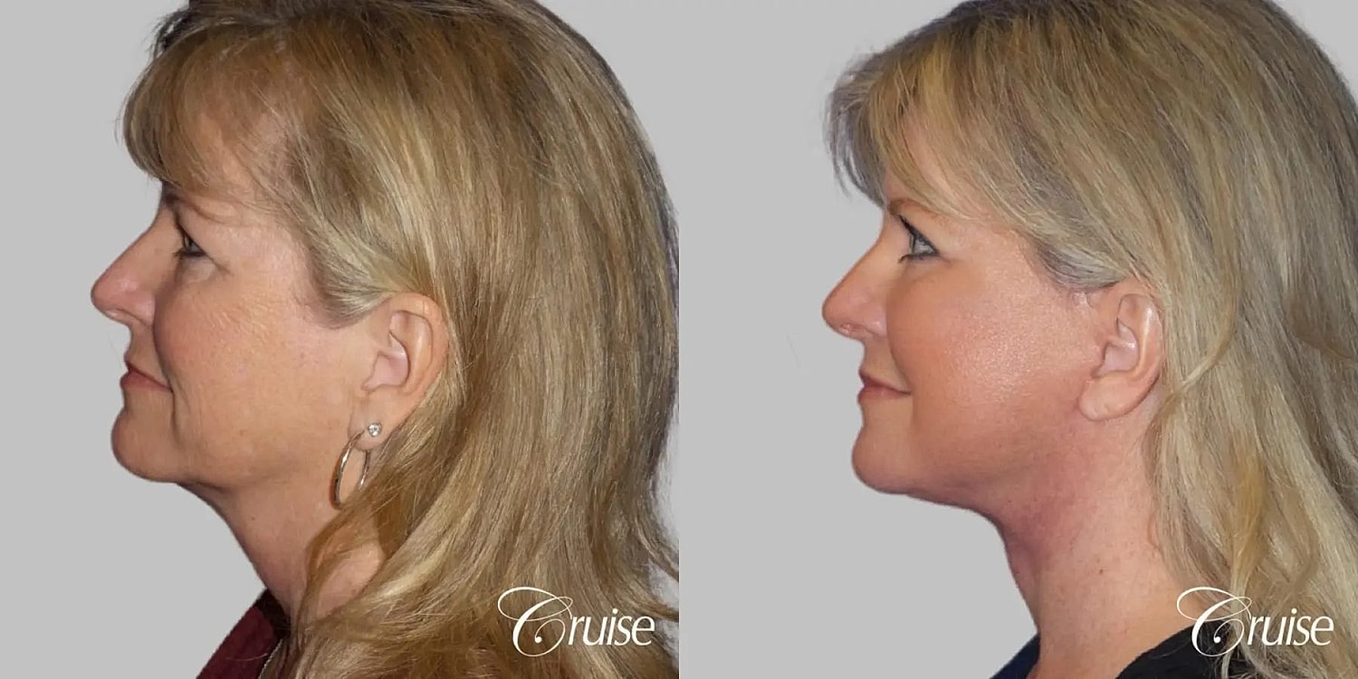 Face Lift Before & After