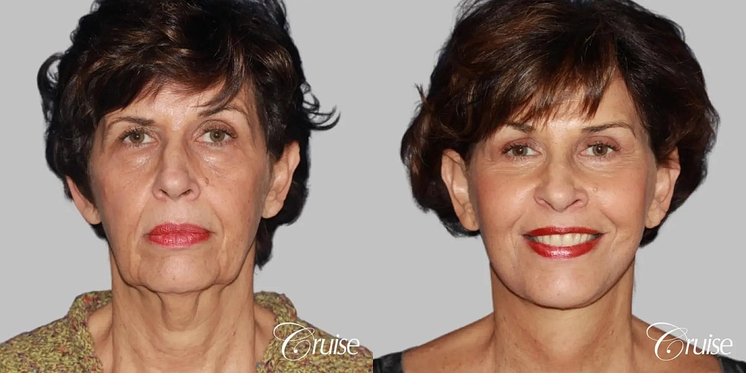 Face Lift Before & After