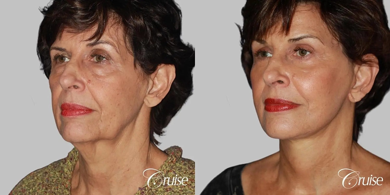 Face Lift Before & After