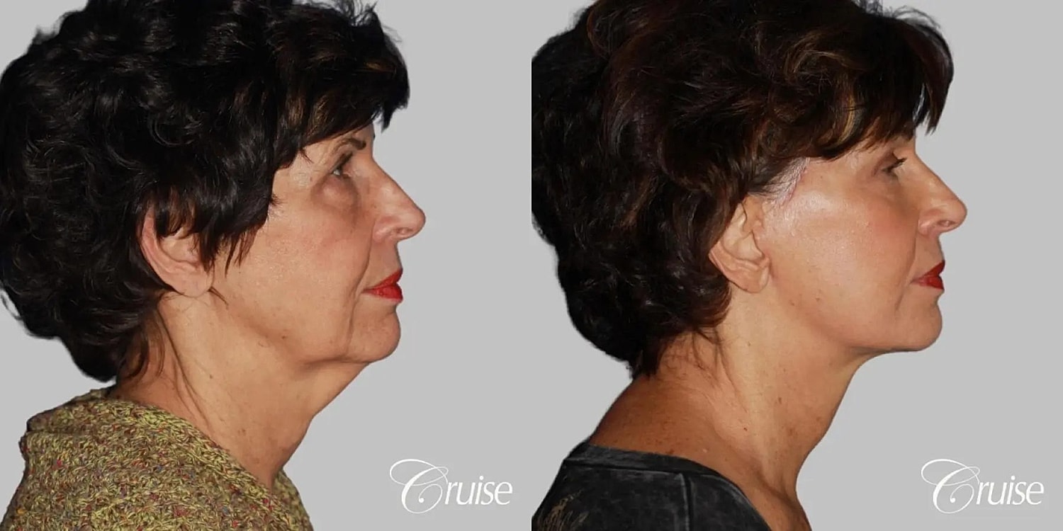 Face Lift Before & After