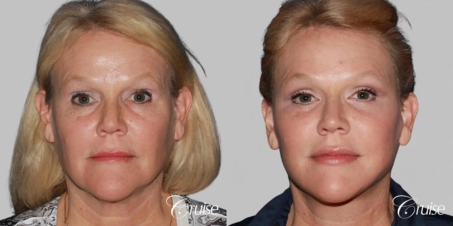 Face Lift Before & After