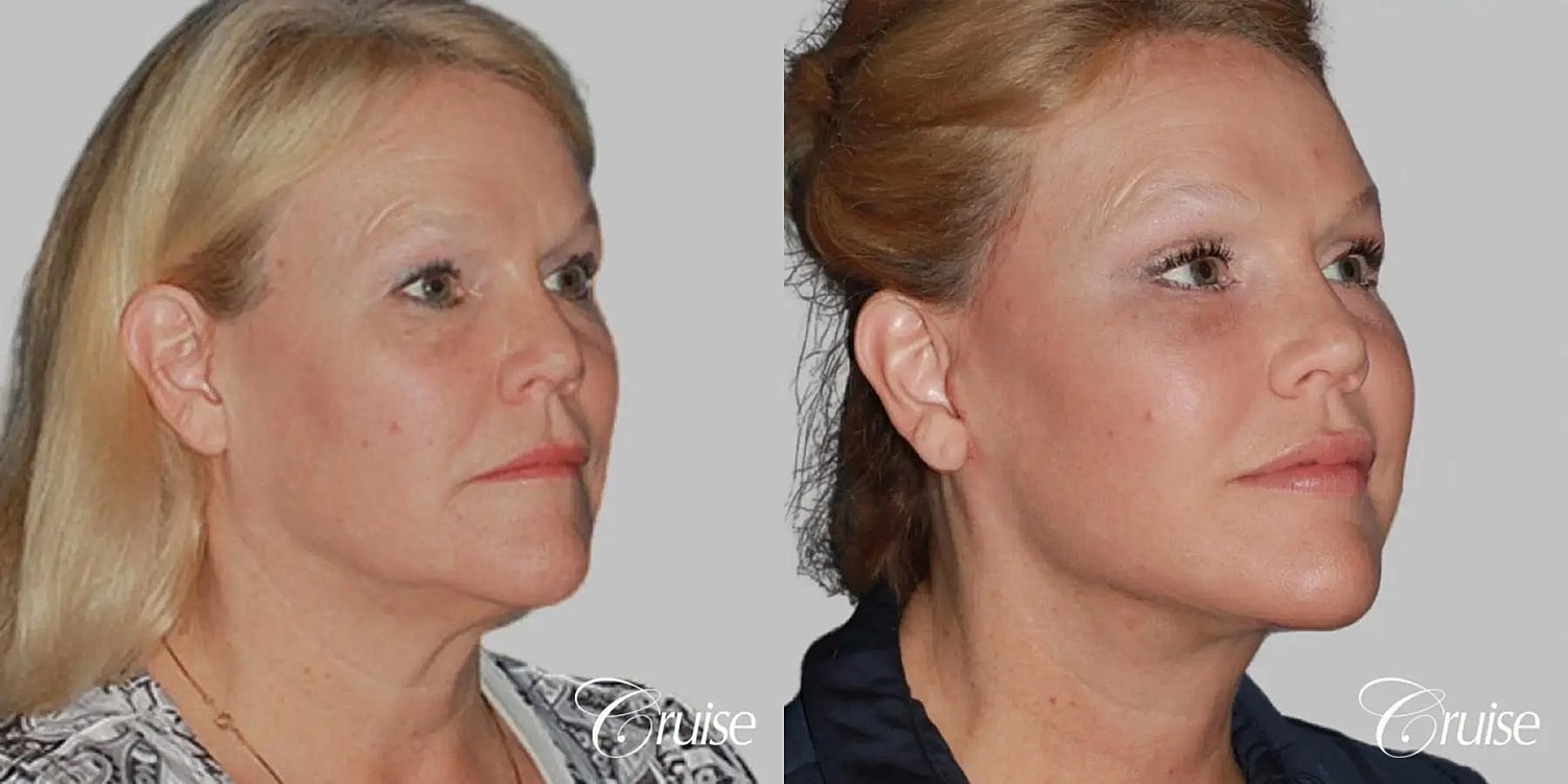 Face Lift Before & After