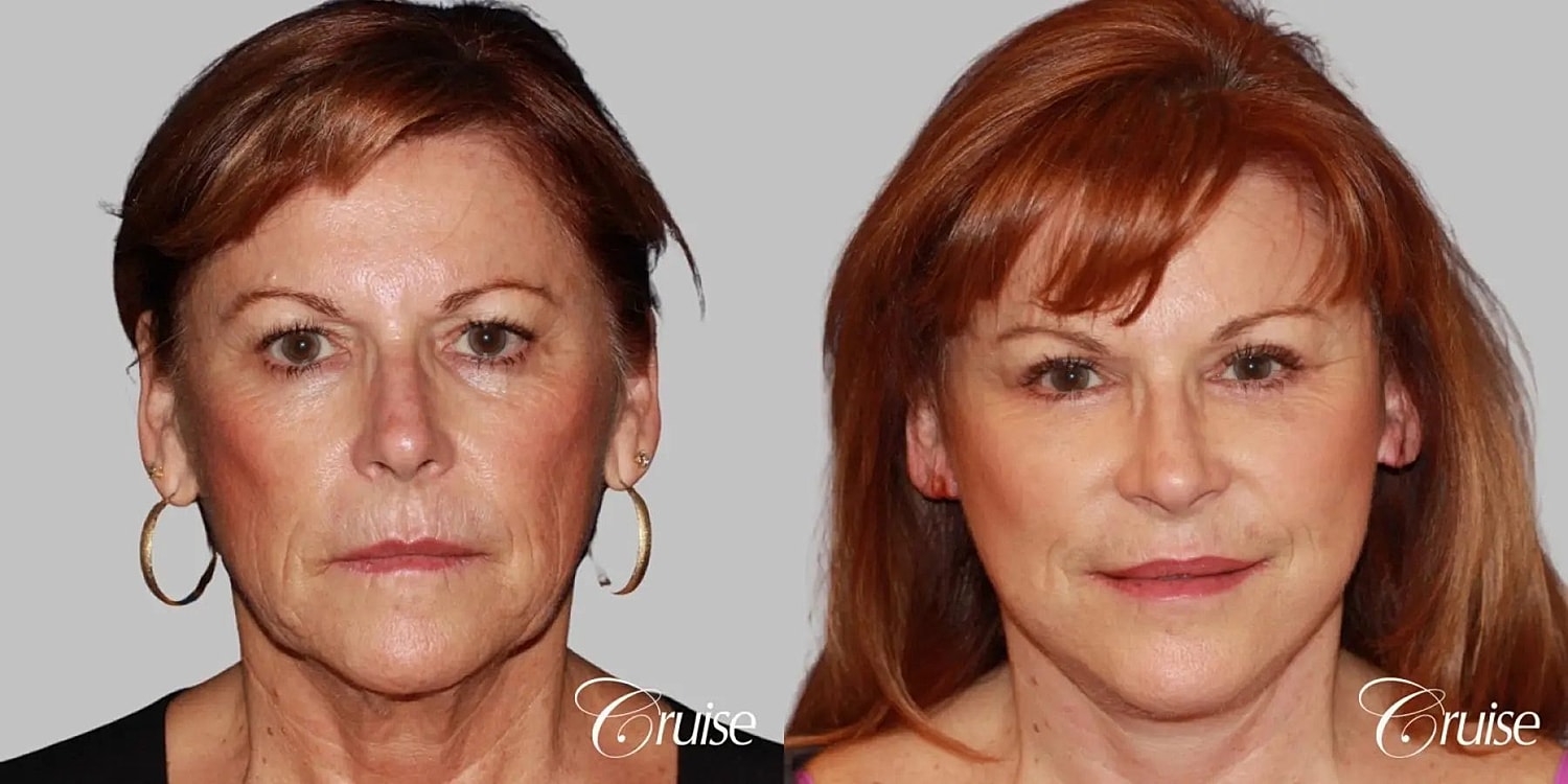 Face Lift Before & After