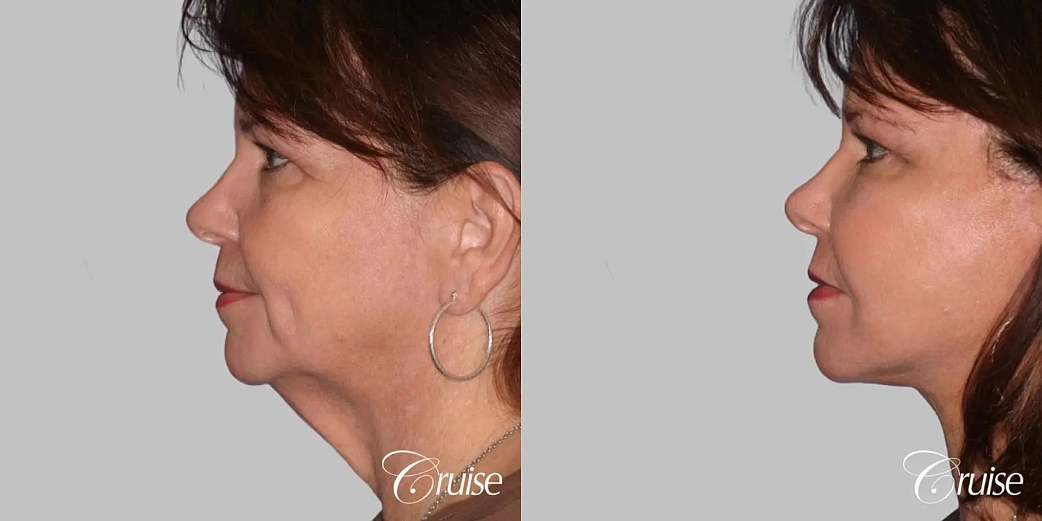 Face Lift Before & After