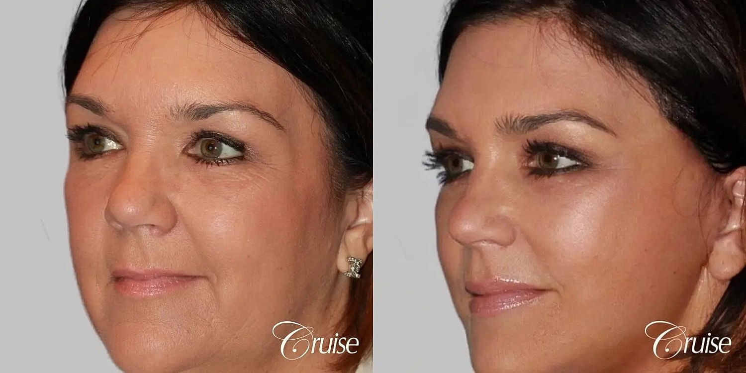 Face Lift Before & After
