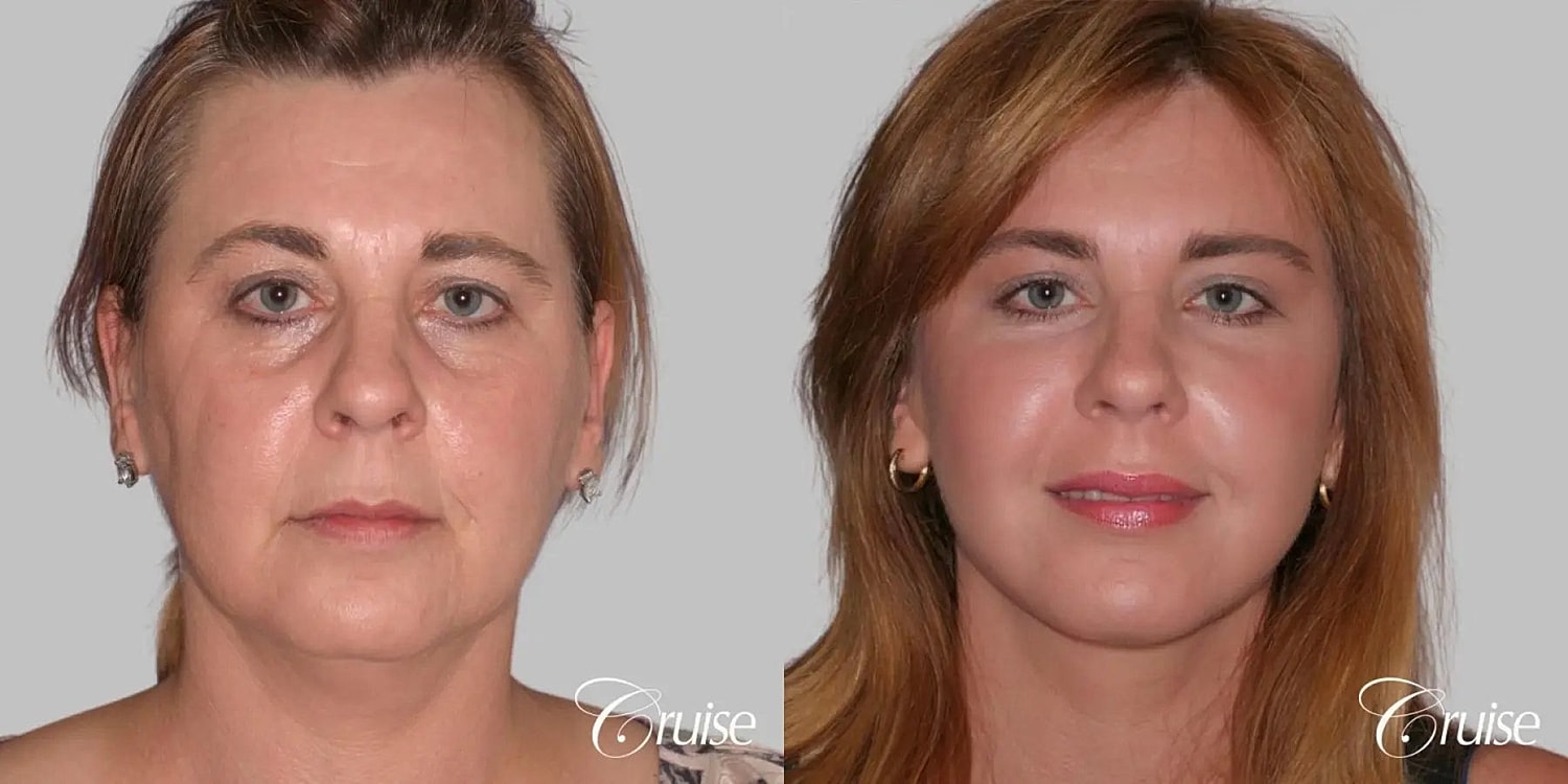 Face Lift Before & After