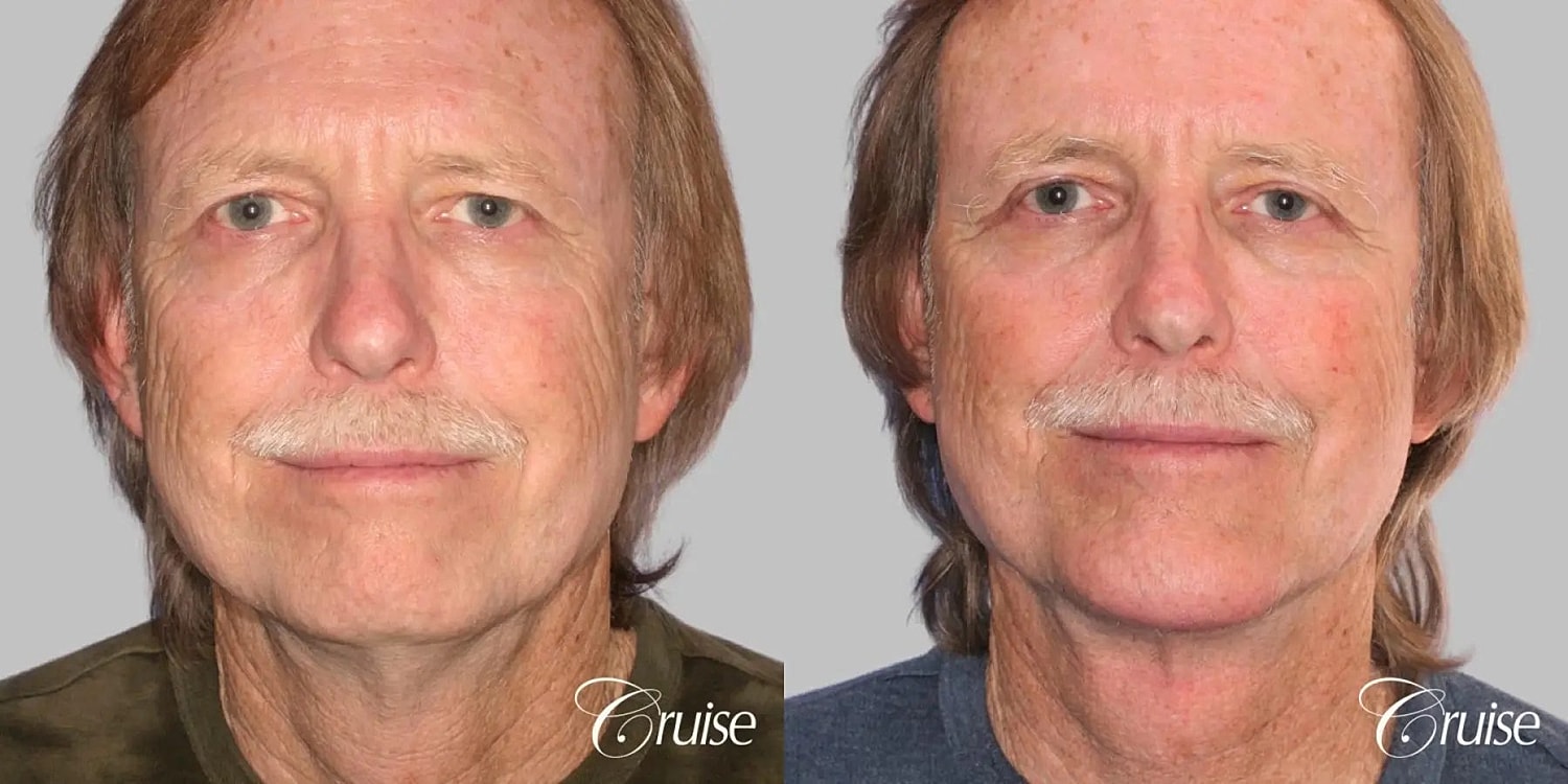 Face Lift Before & After