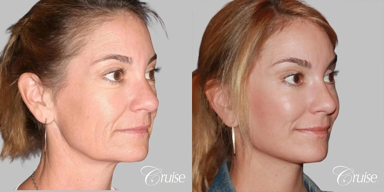 Face Lift Before & After