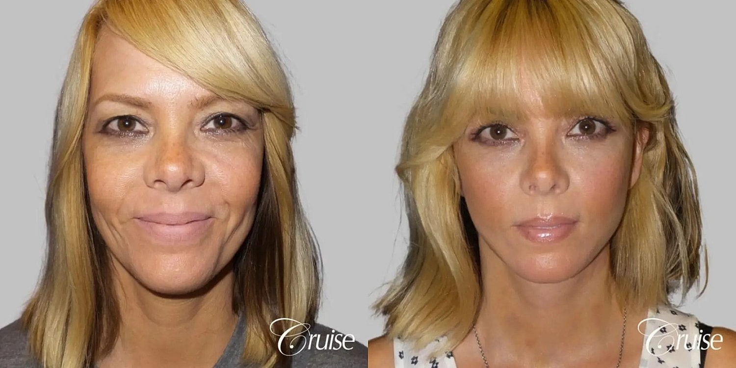 Face Lift Before & After