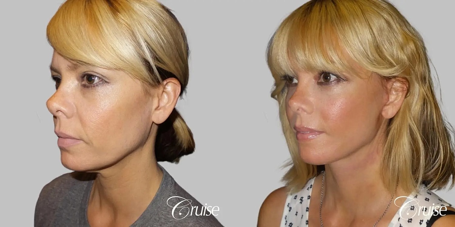 Face Lift Before & After