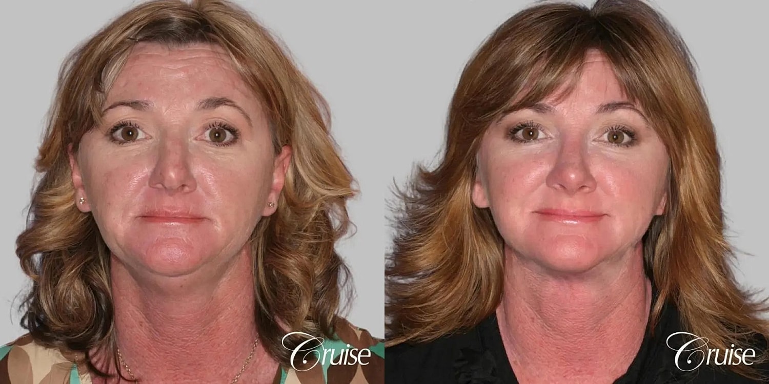 Face Lift Before & After