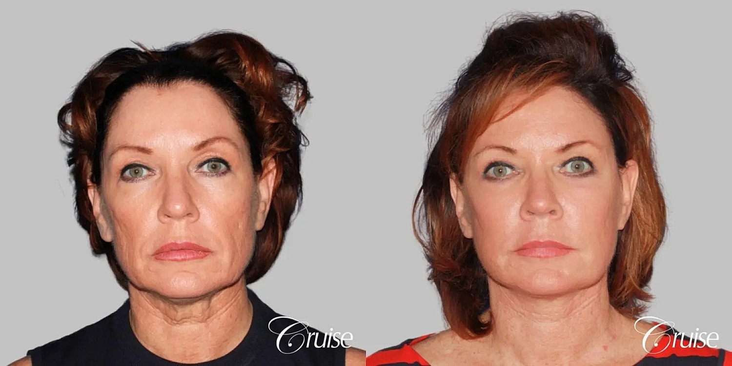 Face Lift Before & After