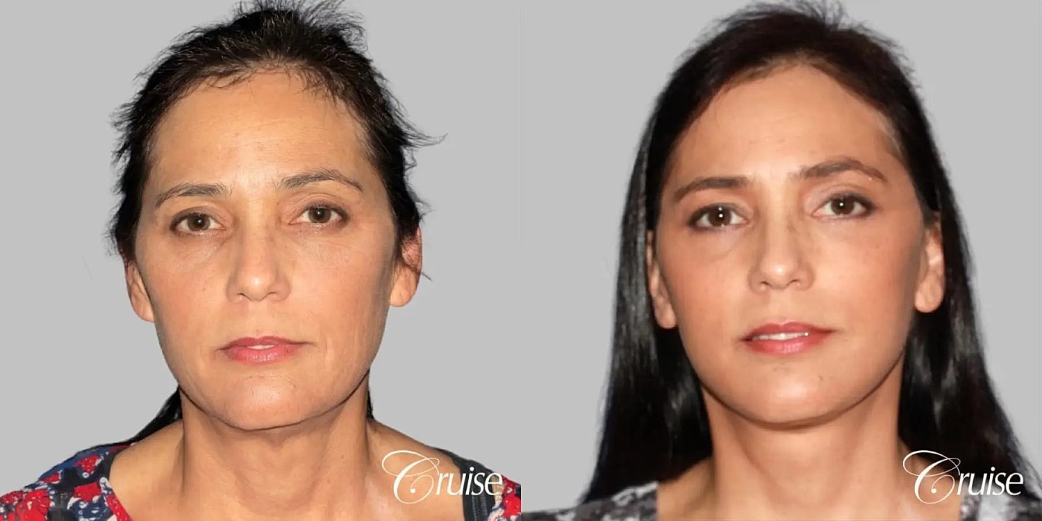 Face Lift Before & After