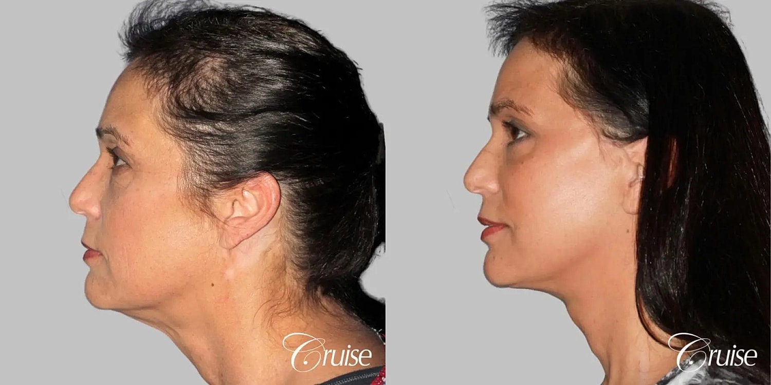 Face Lift Before & After